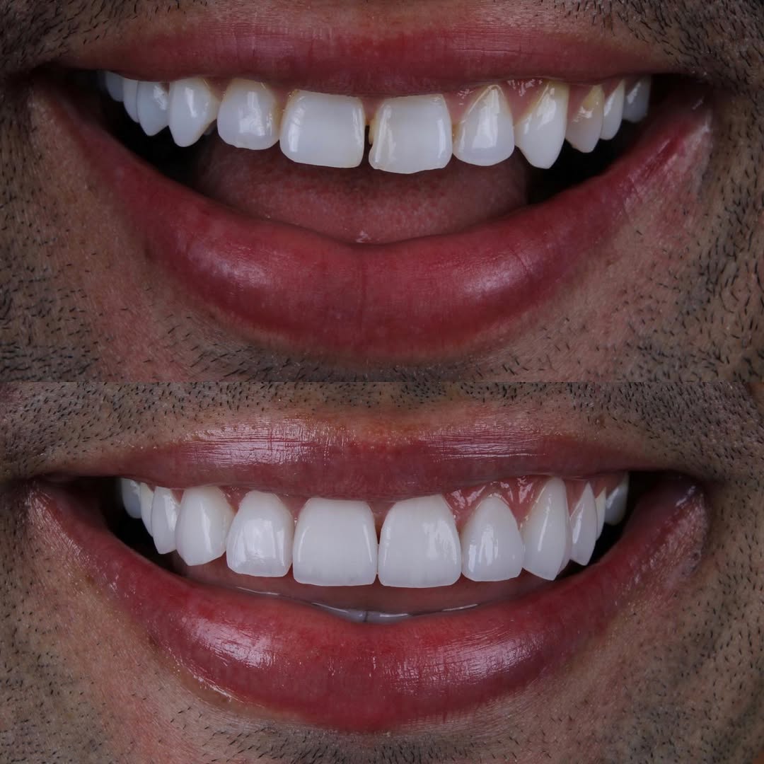Antes e depois — caso 4